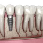Pioneering Pain Management in Dental Implant Procedures