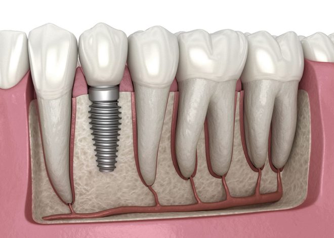 Pioneering Pain Management in Dental Implant Procedures