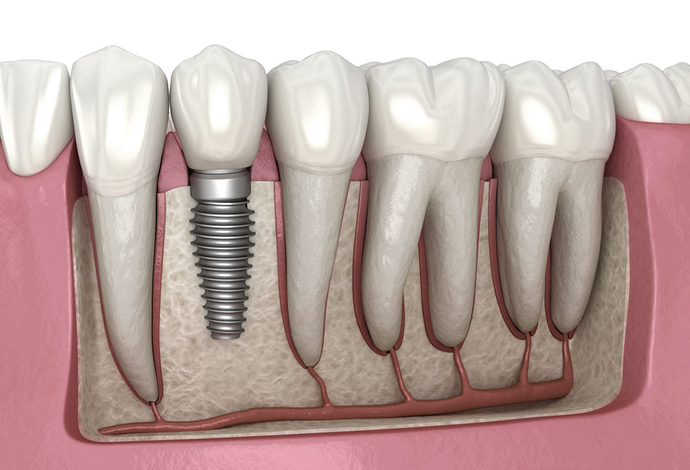 Pioneering Pain Management in Dental Implant Procedures