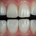What Happens to Composite Bonding Over Time and How to Maintain It