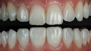 What Happens to Composite Bonding Over Time and How to Maintain It
