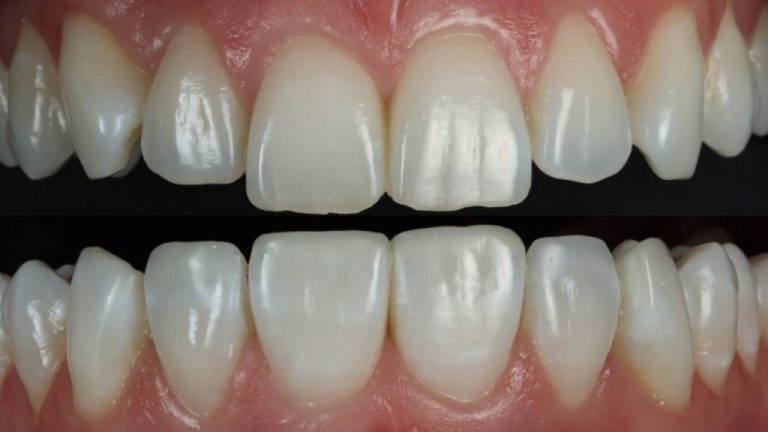 What Happens to Composite Bonding Over Time and How to Maintain It